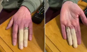 Syndrom Raynauda: Jak rozpoznać objawy i co je wywołuje?