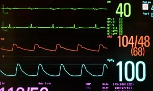 Monitor medyczny pokazuje wysokie ciśnienie 104/48 i niski puls 40. Przyczyna tego stanu może być złożona.