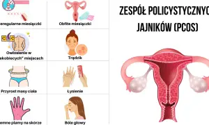 Zespół policystycznych jajników: Objawy, diagnoza i jak sobie z nim radzić