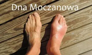 Dwa stopy na drewnianym tle, jeden zdrowy, drugi opuchnięty i zaczerwieniony.