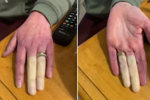 Syndrom Raynauda: Jak rozpoznać objawy i co je wywołuje?