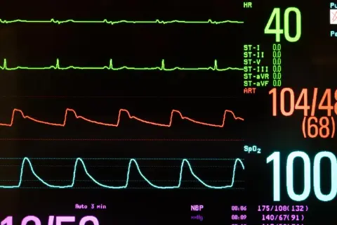 Monitor medyczny pokazuje wysokie ciśnienie 104/48 i niski puls 40. Przyczyna tego stanu może być złożona.