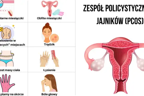 Zespół policystycznych jajników: Objawy, diagnoza i jak sobie z nim radzić