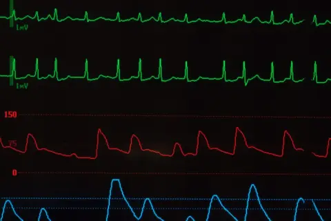 Monitor EKG pokazuje nieregularne fale, co może sugerować migotanie przedsionków. Długość życia z migotaniem przedsionków zależy od wielu czynników.