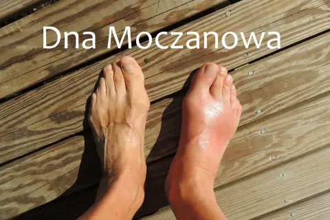 Dwa stopy na drewnianym tle, jeden zdrowy, drugi opuchnięty i zaczerwieniony.