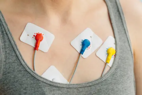 Elektrody EKG na klatce piersiowej, monitorujące pracę serca pod kątem arytmii.
