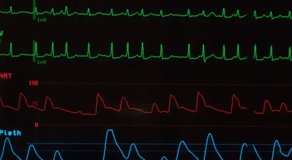 Monitor EKG pokazuje nieregularne fale, co może sugerować migotanie przedsionków. Długość życia z migotaniem przedsionków zależy od wielu czynników.