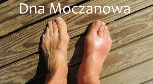 Dwa stopy na drewnianym tle, jeden zdrowy, drugi opuchnięty i zaczerwieniony.