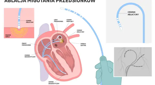 Ilustracja pokazuje, jak ablacja serca co to jest: cewniki wprowadzane do serca, by zlokalizować i zniszczyć źródło arytmii.