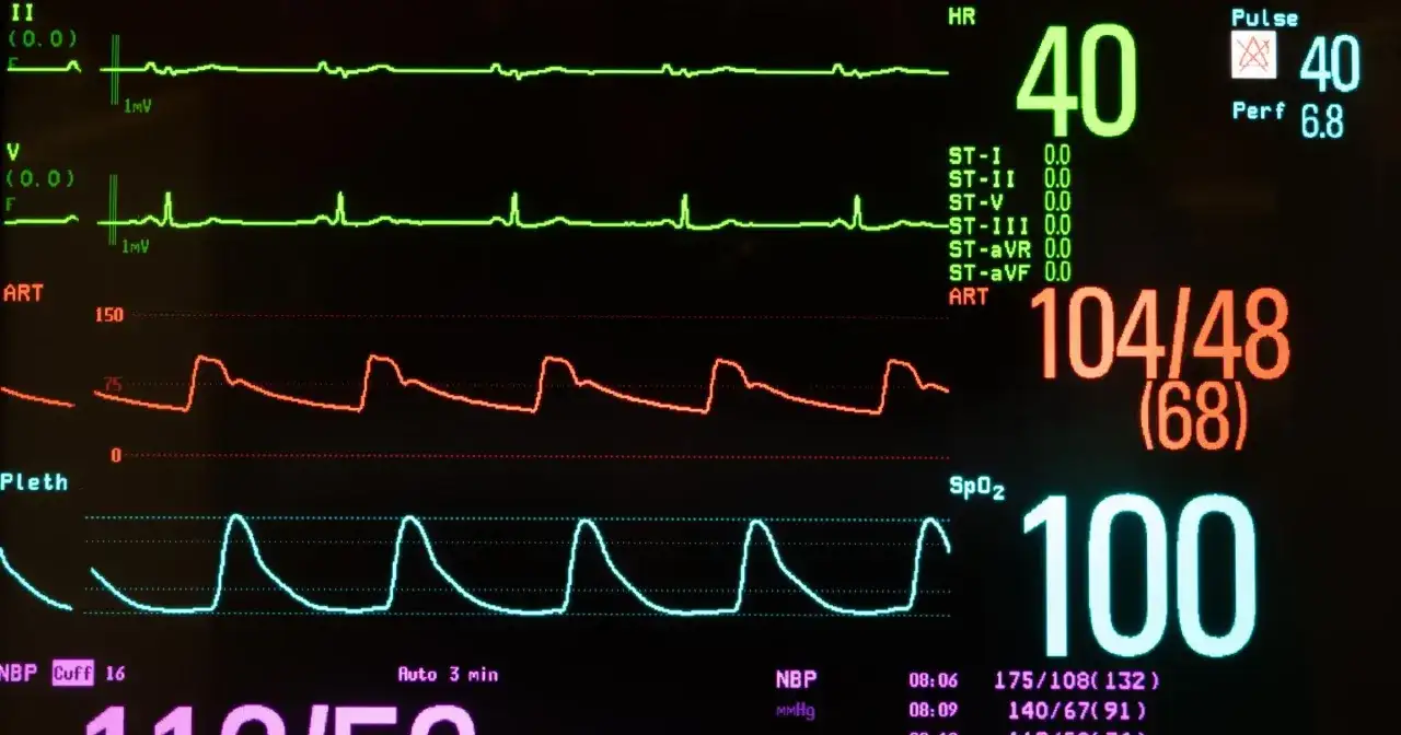 Monitor medyczny pokazuje wysokie ciśnienie 104/48 i niski puls 40. Przyczyna tego stanu może być złożona.