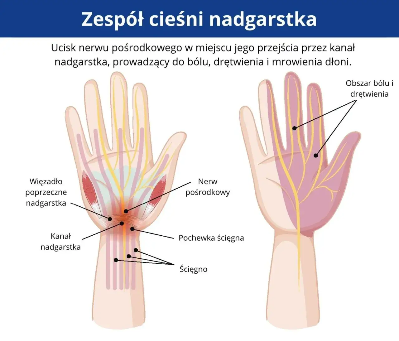 Zdjęcie Zesp&oacute;ł cieśni nadgarstka: objawy, kt&oacute;re musisz znać.