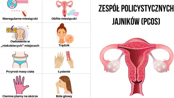 Zespół policystycznych jajników: Objawy, diagnoza i jak sobie z nim radzić