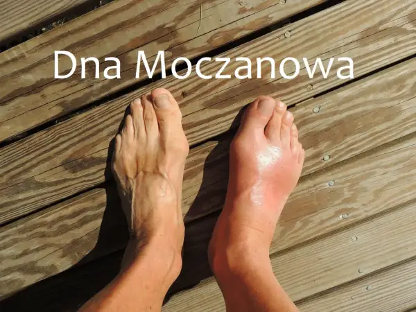 Dwa stopy na drewnianym tle, jeden zdrowy, drugi opuchnięty i zaczerwieniony.
